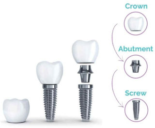 https://amazingdentalbaja.com/wp-content/uploads/2025/09/impalnt1-320x264.png